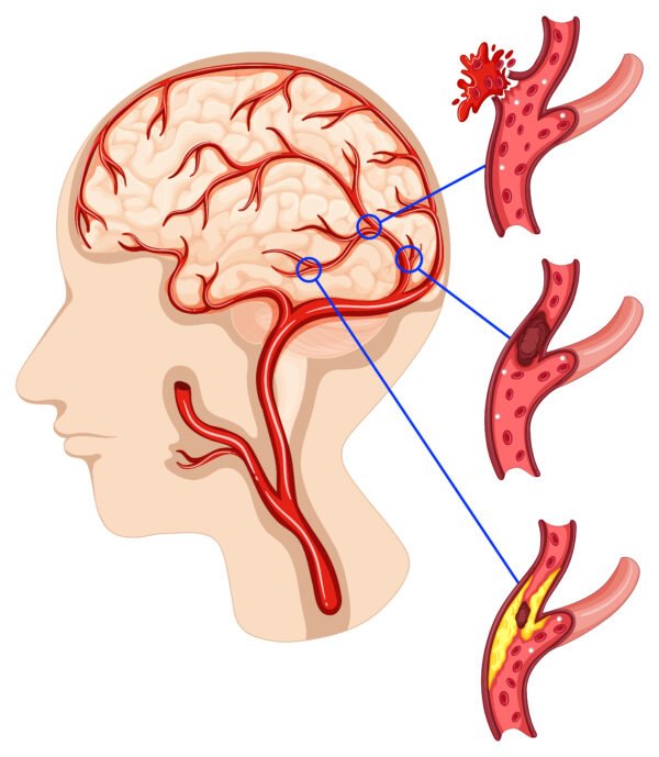 Caner in human brain illustration