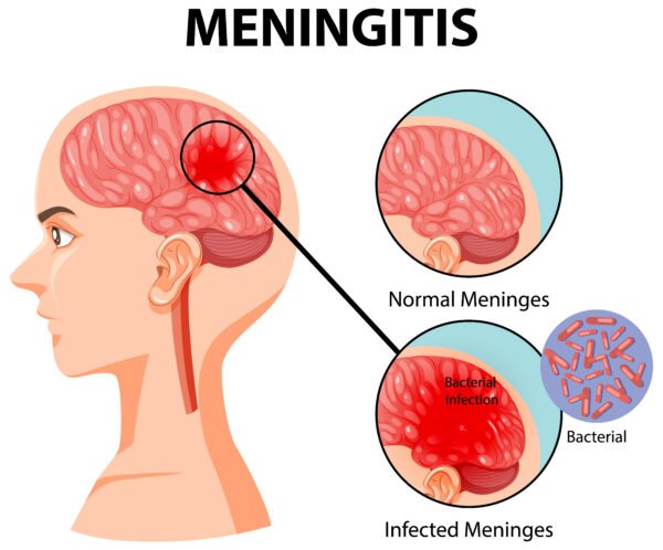 Diagram showing meningitis in human brain illustration
