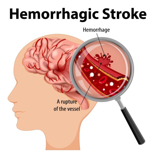 Human with Hemorrhagic stroke illustration