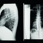 High-resolution X-ray showing a detailed examination of human spine with scoliosis.